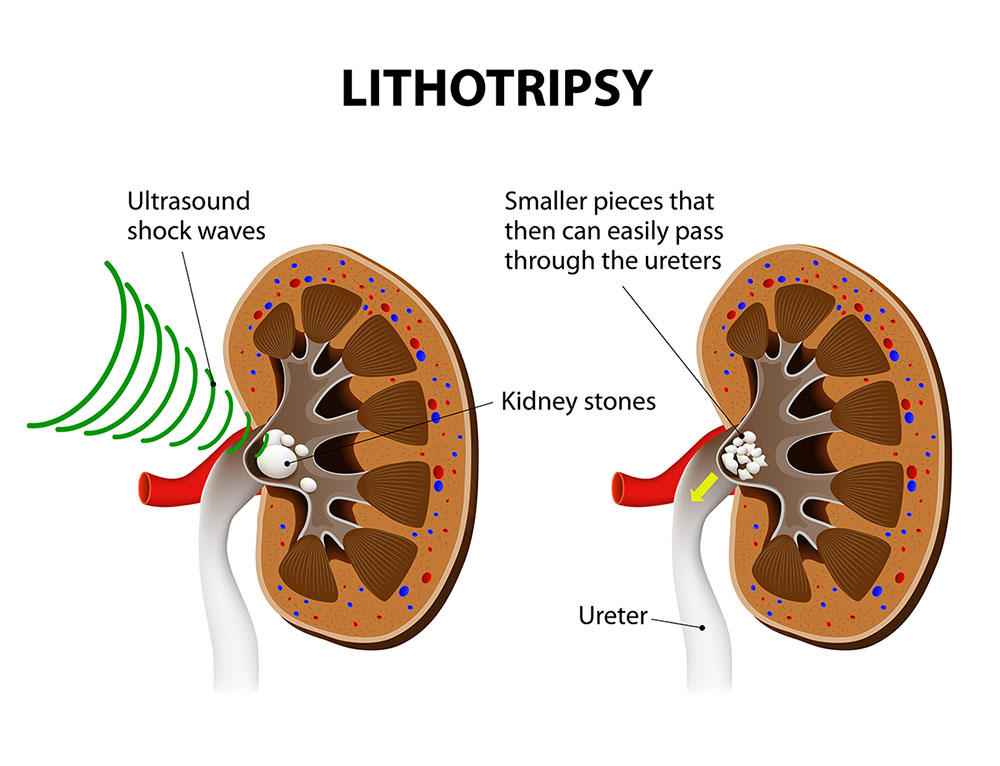 Kidney Stone