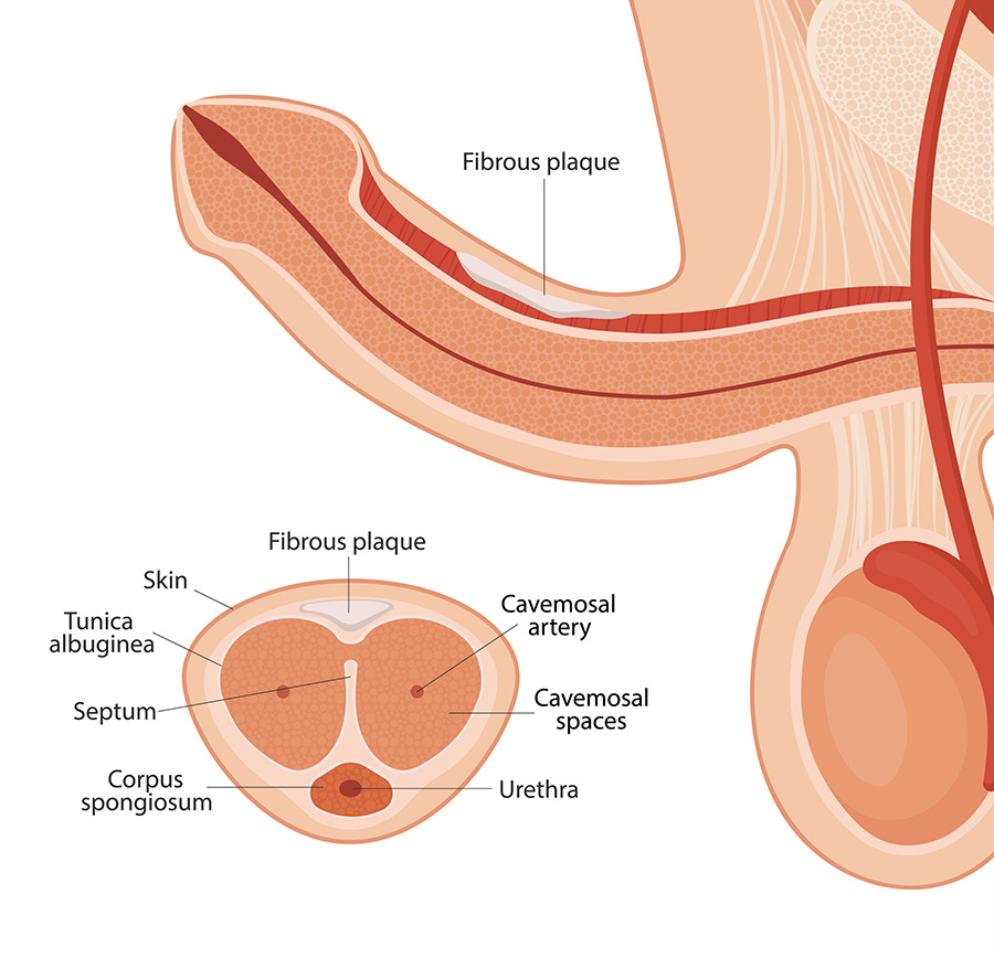 Peyronies-Disease